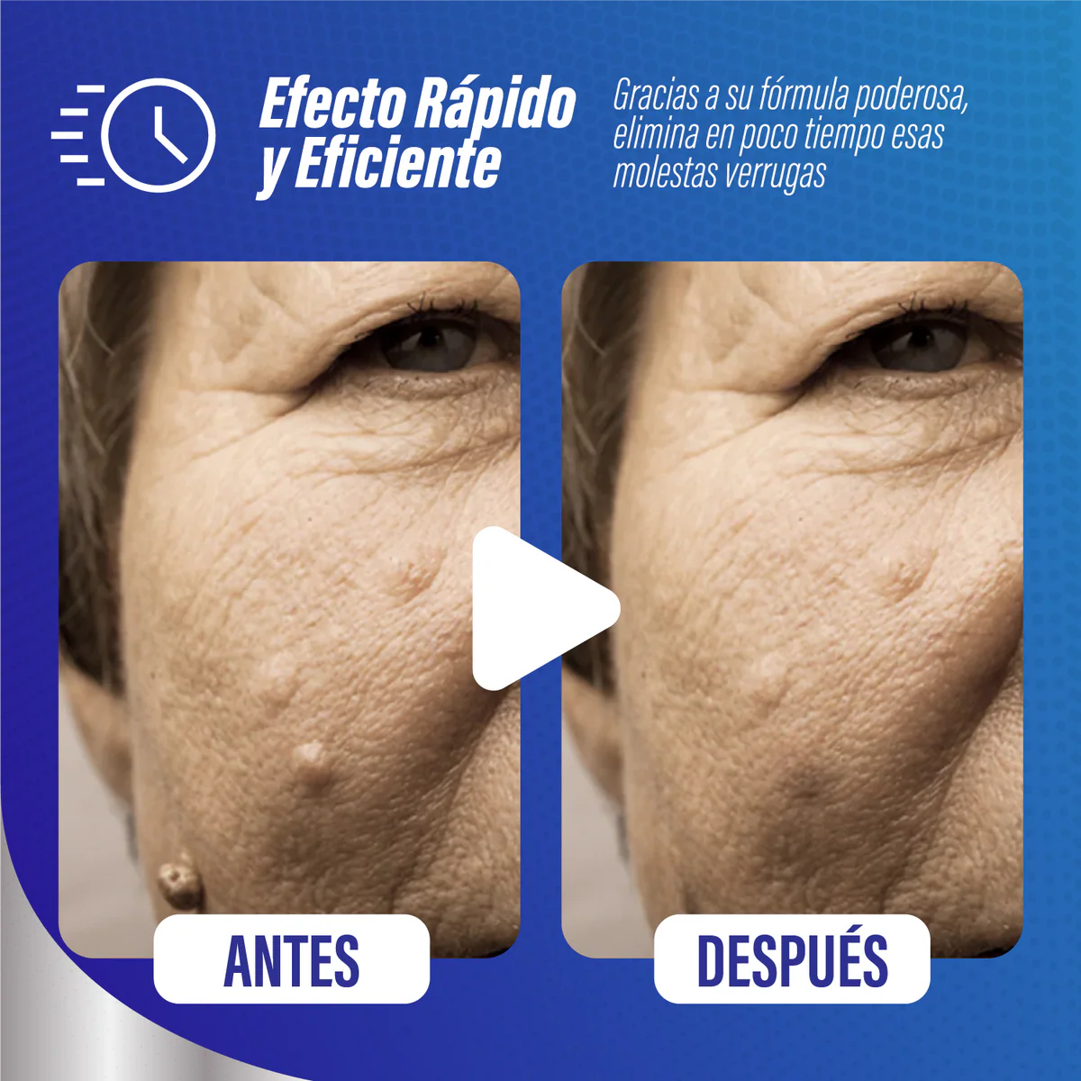 WARTOFF® REMOVEDOR DE VERRUGAS